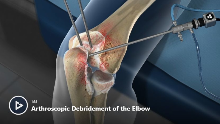 Elbow Ligament Injuries, OrthoUtah, Orthopaedic Surgeons Brigham City