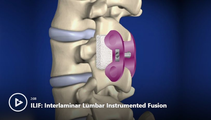 Spinal Cord Stimulator Implant Video