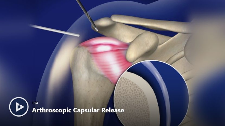 Shoulder Impingement Syndrome (Bursitis or Tendonitis) | Orthopedists ...