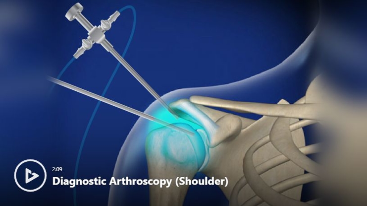 Shoulder Conditions & Treatments Videos | Newport Orthopedic Institute