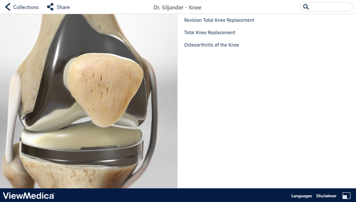 Partial Knee Replacement With Oxford® Implant Video Newport