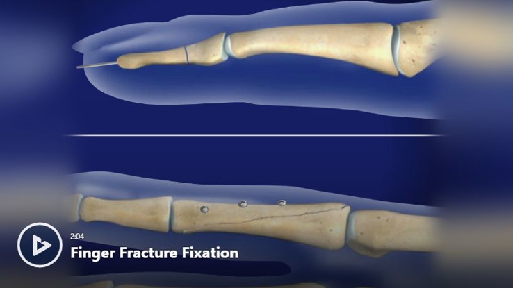 Hand Wrist Conditions Treatments Videos Newport Orthopedic Institute