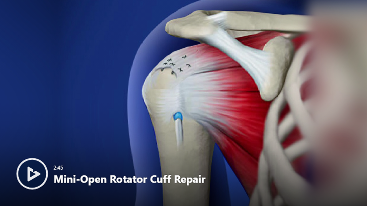 Shoulder Conditions & Treatments Videos | Newport Orthopedic Institute