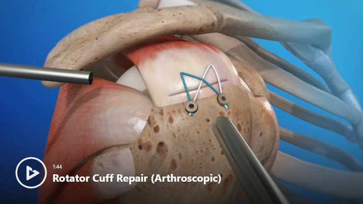 Shoulder Conditions & Treatments Videos | Newport Orthopedic Institute