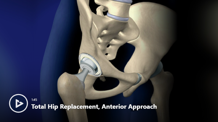 Hip Replacement in Orange County, CA | Orthopedists Newport Beach, CA