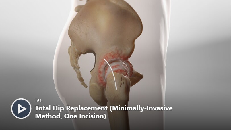 Hip Arthritis  Orthopedic Services Newport Beach, CA